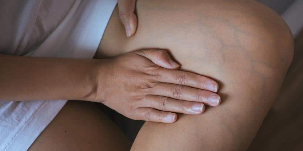 What Can I Do About Spider Veins?