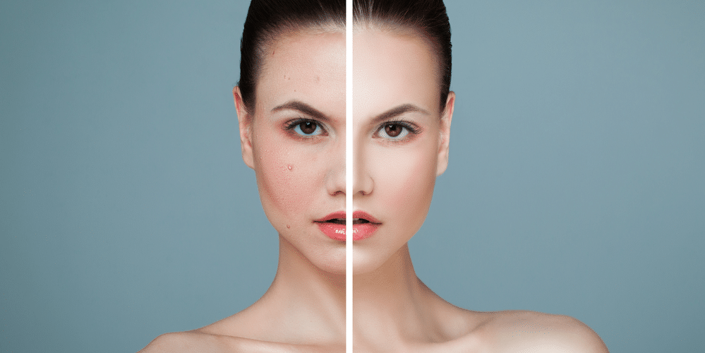Rosacea