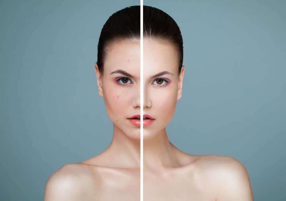 Rosacea