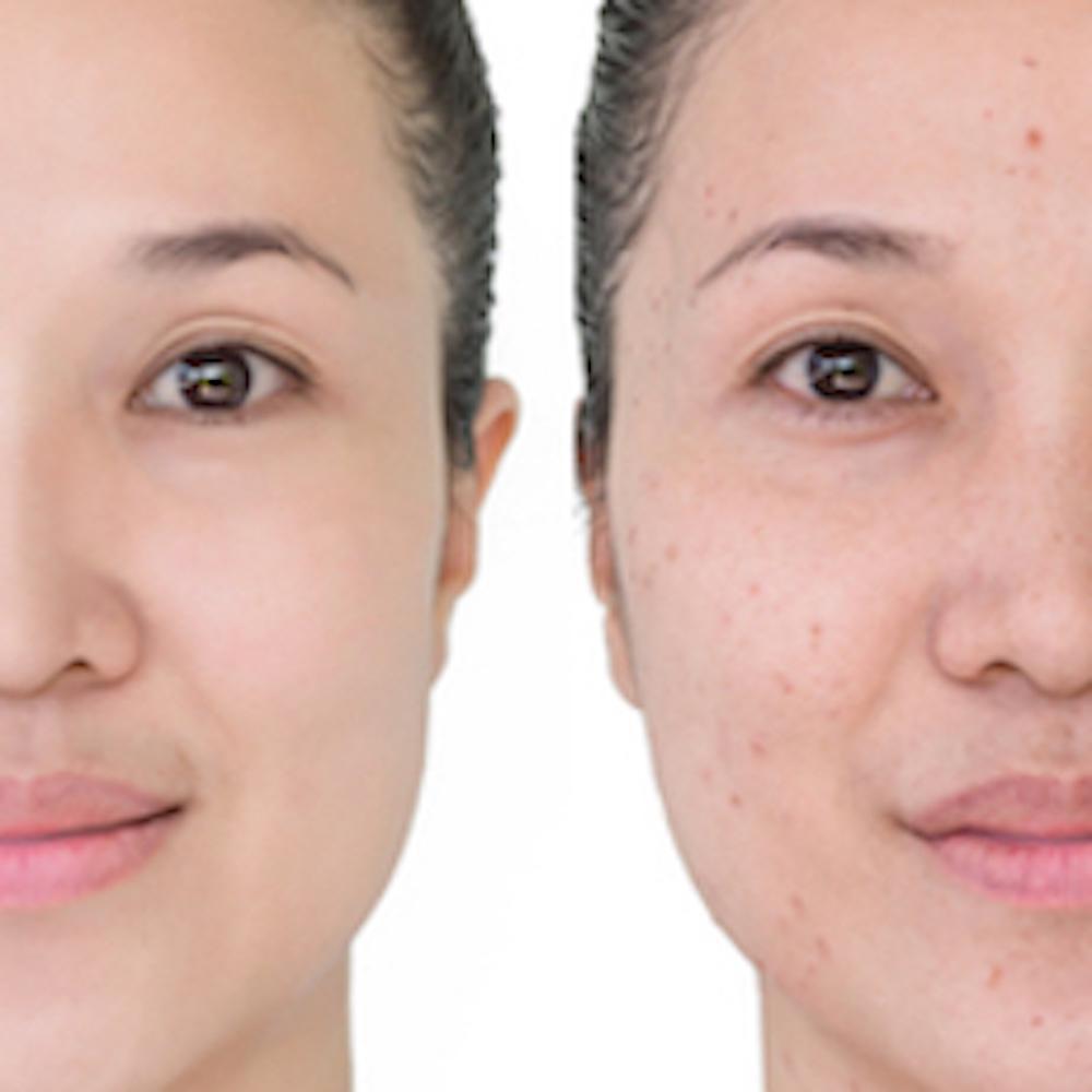 Before and After face treatment