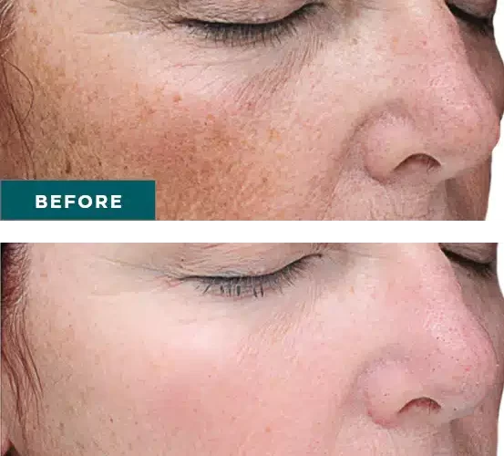Before And After