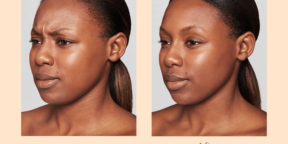 Before And After Image After Dysport