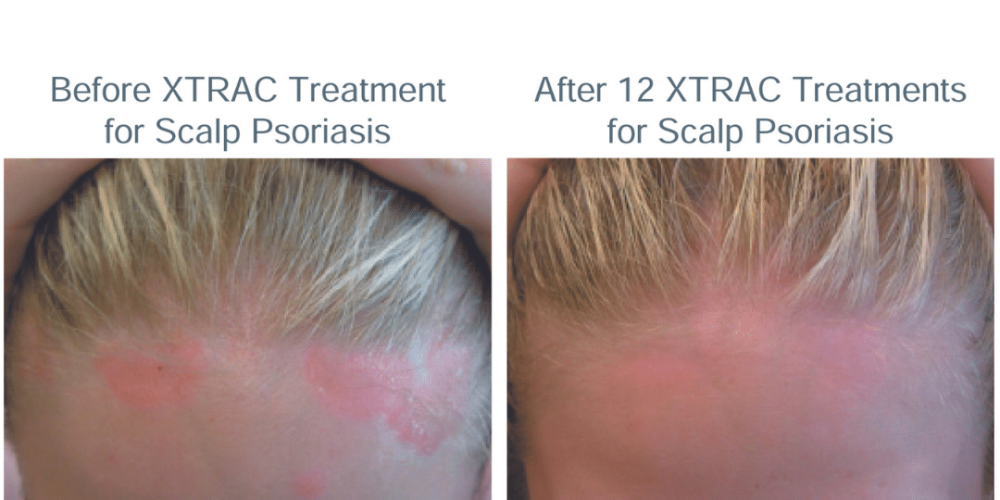 Before And After Scalp Psoriasis