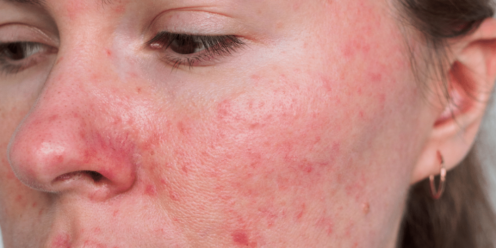 Woman With A Lot Of Red Spots In Her Face