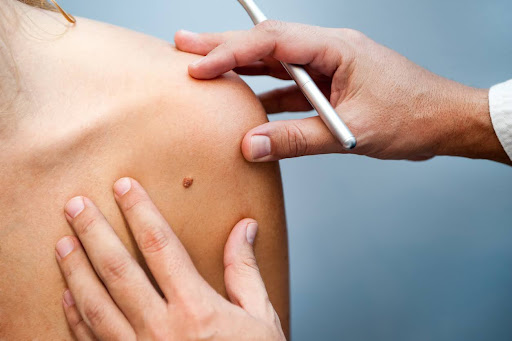 A Doctor Holds A Pen And Examines A Mole On A Female Patient’s Shoulder