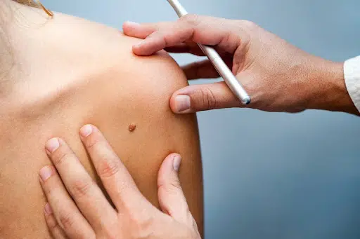 A doctor holds a pen and examines a mole on a female patient’s shoulder