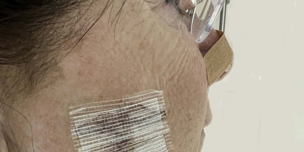 Side View Of A Woman's Face With A Bandage After Recent Mohs Surgery