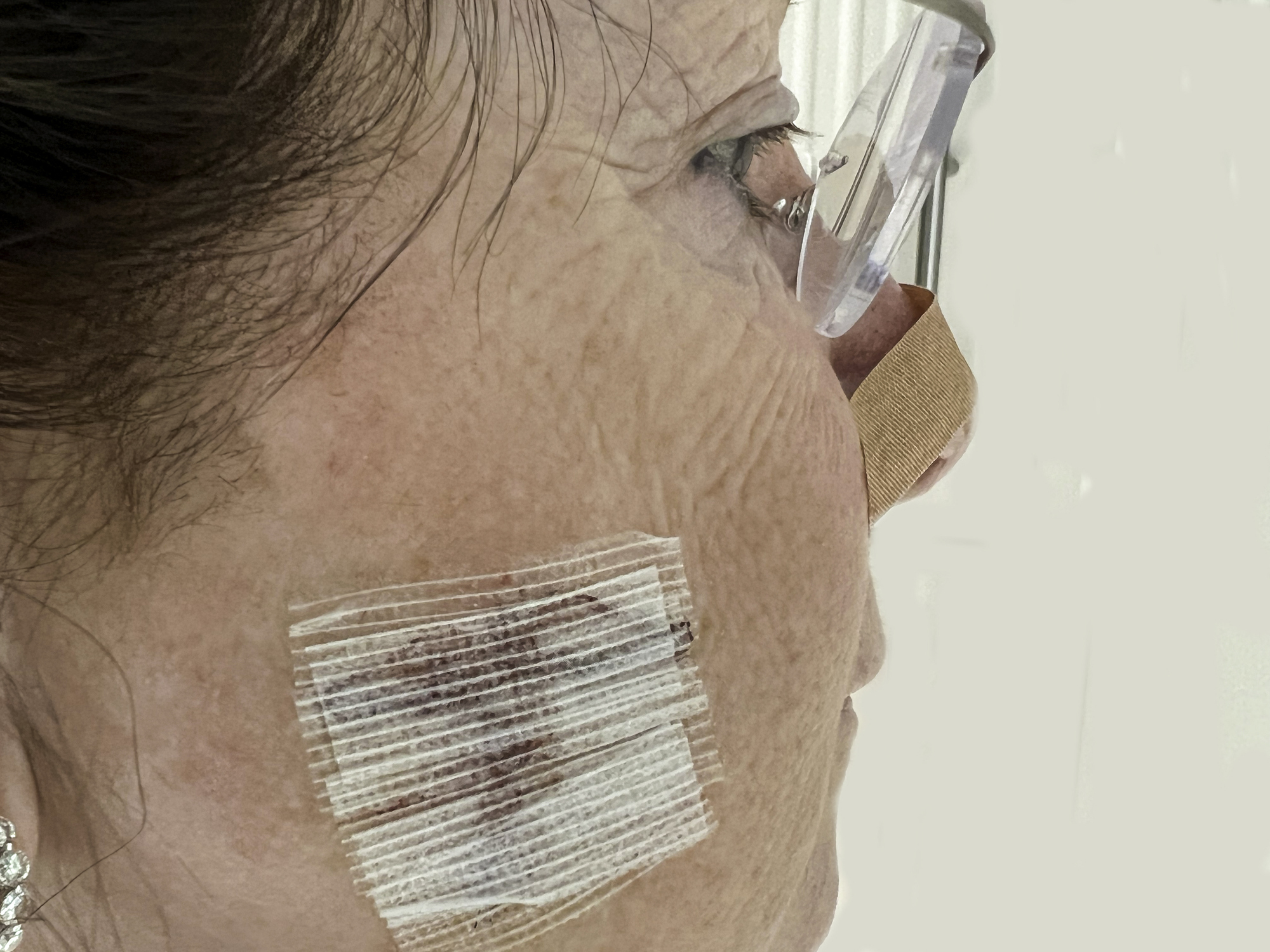 Side view of a woman's face with a bandage after recent Mohs Surgery
