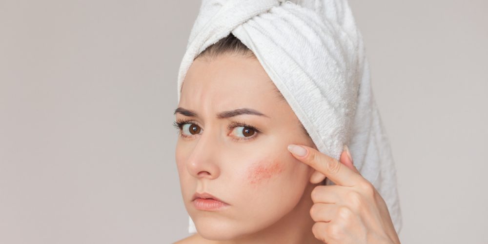 Close-up Photo Of A Young Woman With A White Towel Wrapped Around Her Head Examining A Rosacea Flare-up.