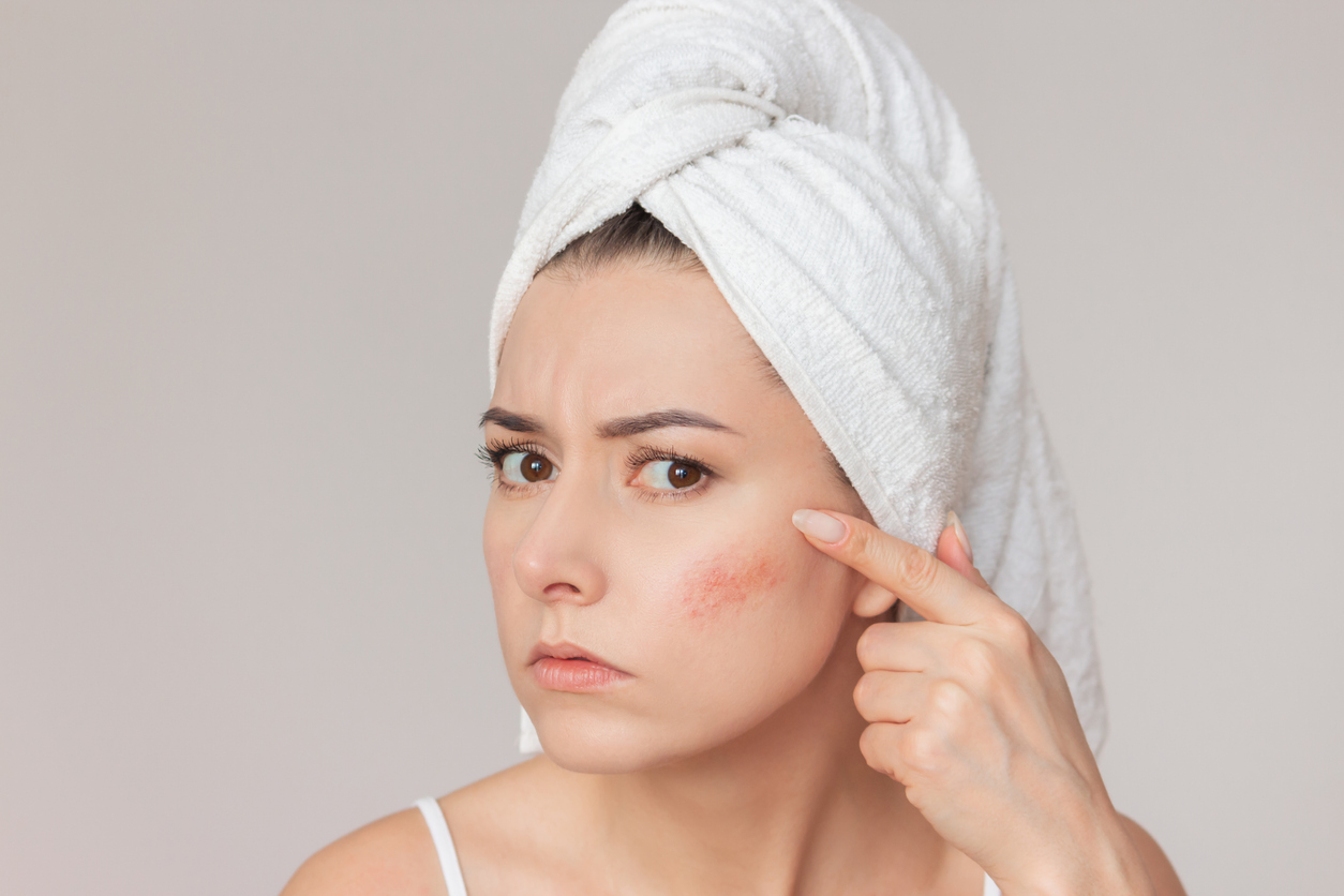 Close-up photo of a young woman with a white towel wrapped around her head examining a rosacea flare-up.