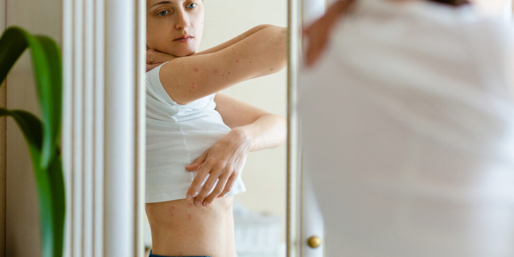 A Woman Wearing A White T-shirt Observing The Beginnings Of A Psoriasis Flare-up On Her Side In A Standing Mirror.