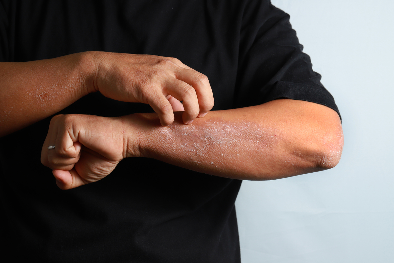 A photo of an adult wearing a black shirt scratching an itchy red patch of eczema on his left arm.