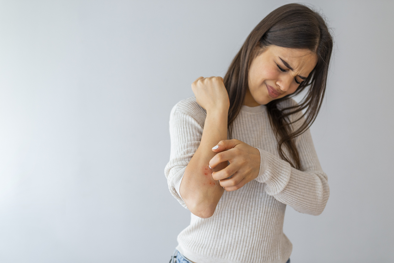 A woman with long, brunette hair winces in pain and scratches her dry, red forearm, experiencing a winter eczema flare-up.