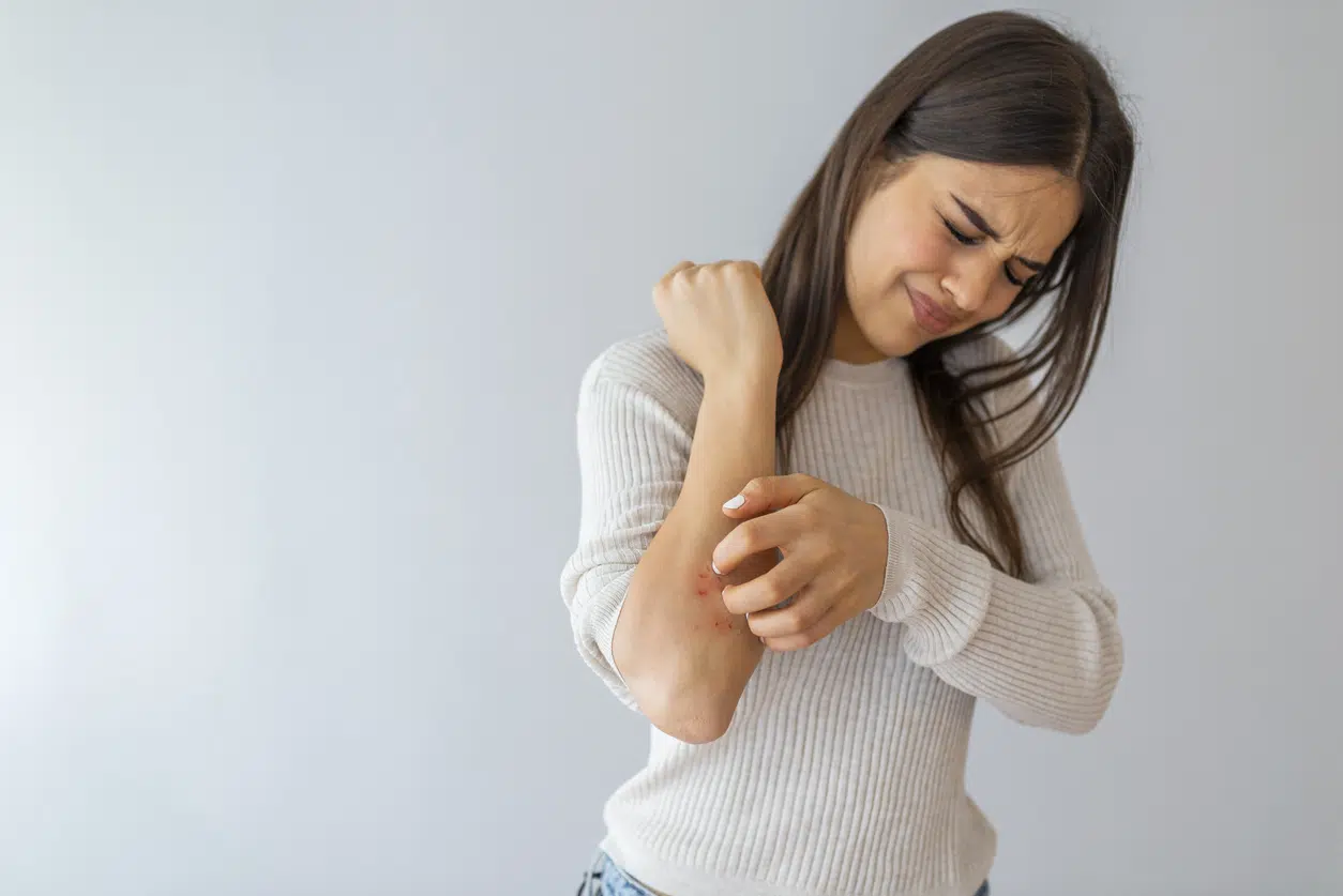 A woman with long, brunette hair winces in pain and scratches her dry, red forearm, experiencing a winter eczema flare-up.