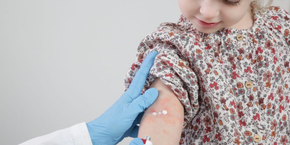 A Child With Contact Dermatitis On Her Arm Gets Professional Allergy Testing To Find The Source Of Her Trigger.