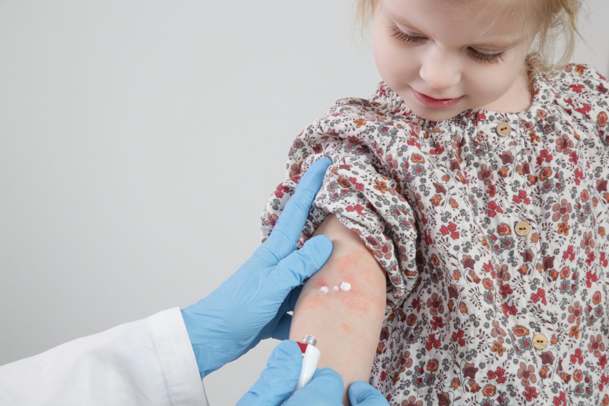 A child with contact dermatitis on her arm gets professional allergy testing to find the source of her trigger.